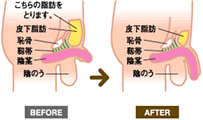 下腹脂肪吸引法